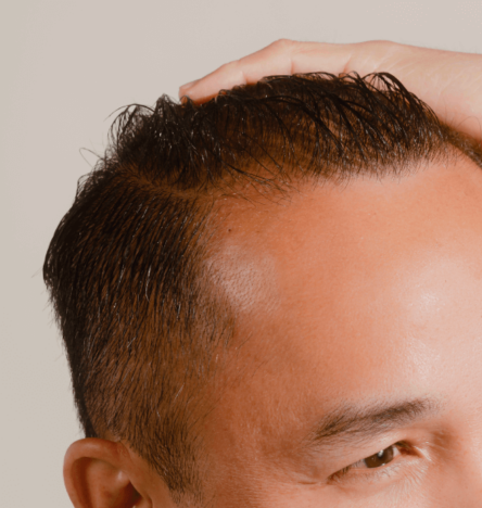 Hair Loss Treatments Online